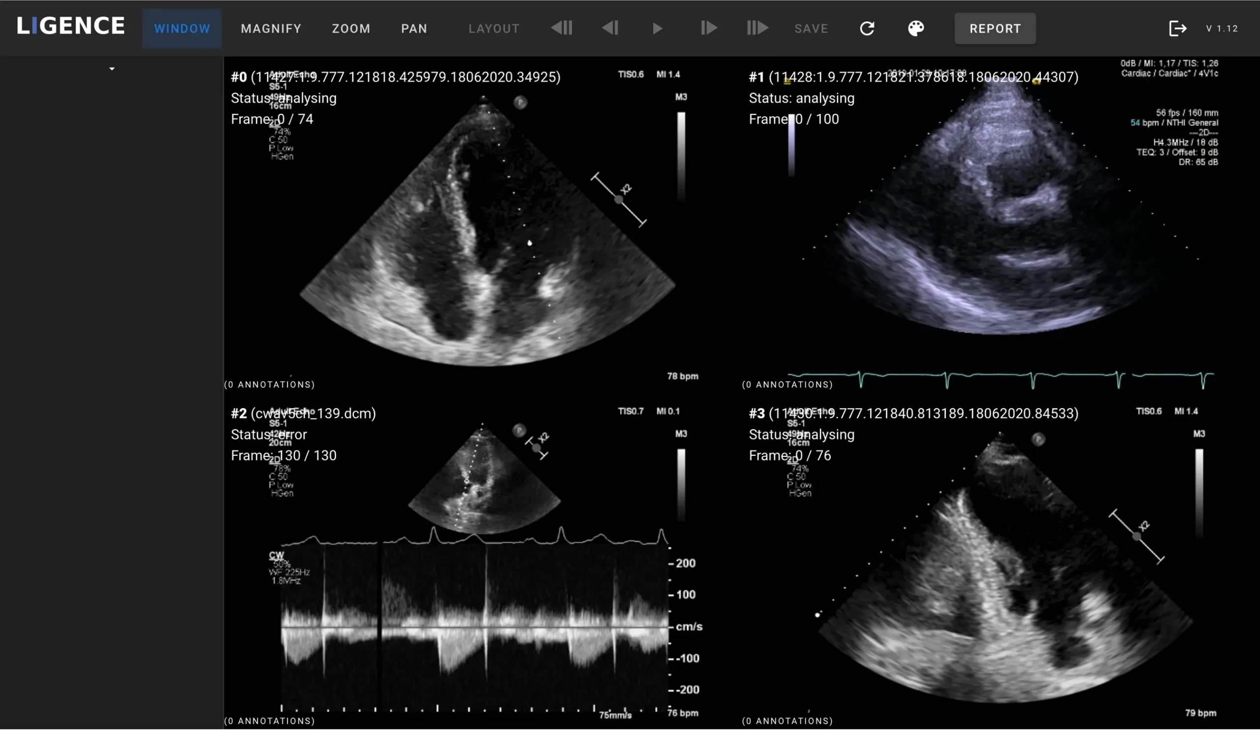 echocardio-raphy-for-covid-19-patients